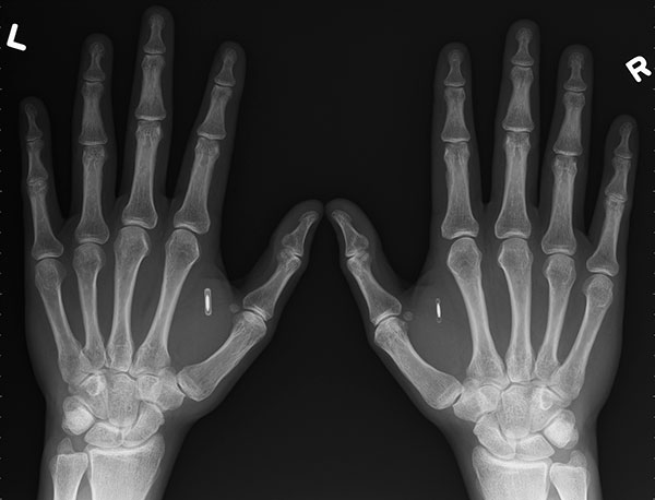 Un hombre se implanta un chip NFC en la mano