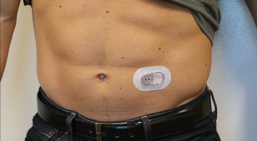 MCG Dexcom G6, tecnología para controlar la diabetes a través del móvil 3 Dexcom 2